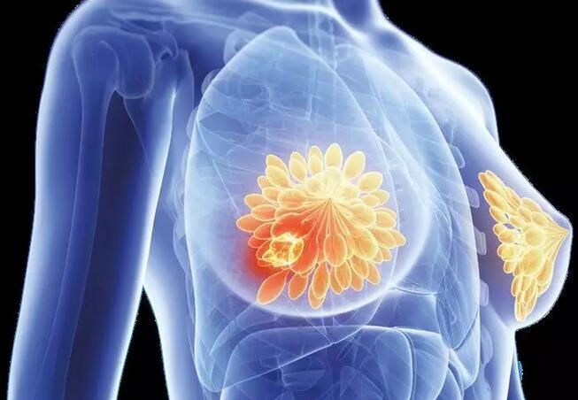 依维莫司 VS 图卡替尼，精准匹配乳腺癌治疗方案